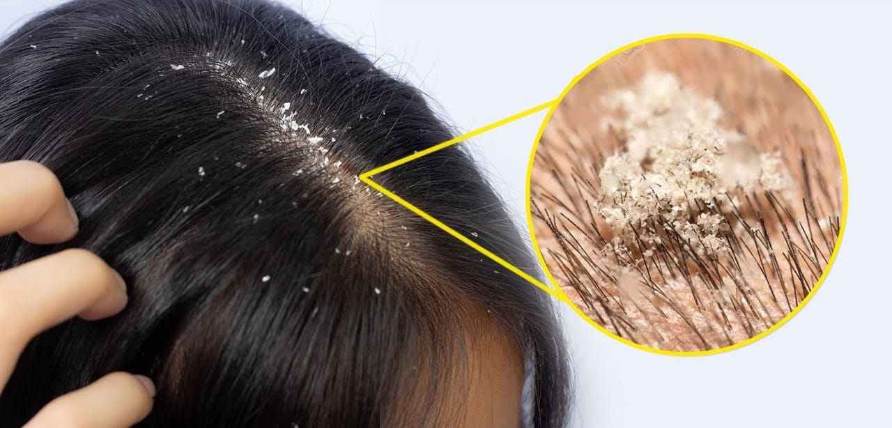 Itchy-Scalp-How-To-Prevent-And-Treatment