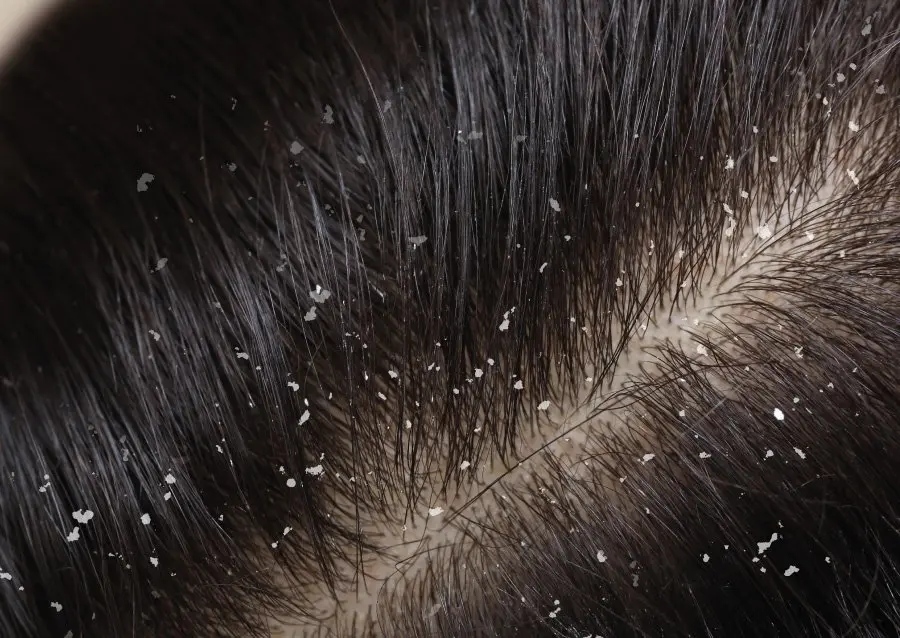 Tea-Tree-Oil-For-Hair-Your-Route-to-Luscious-Healthy-Locks