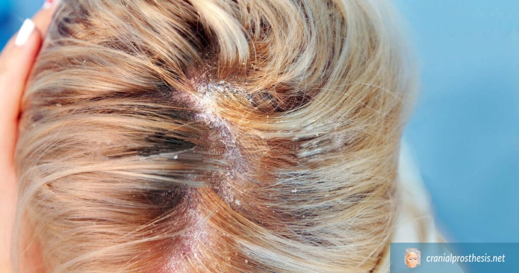 How-To-Deal-With-Sensitive-Scalp