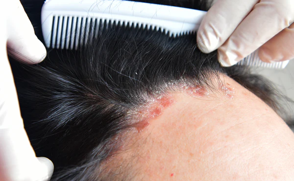 How-To-Deal-With-Sensitive-Scalp